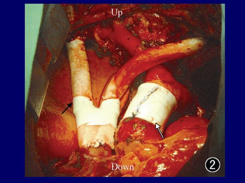Diapositiva 27 de Síndrome Vena Cava Superior