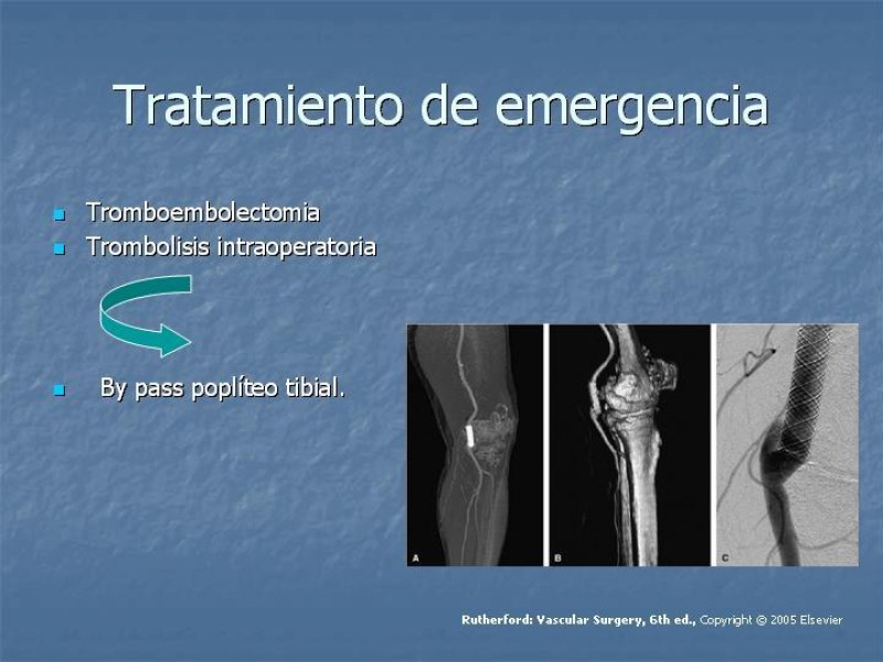 Diapositiva 18 de Aneurisma arterial poplíteo
