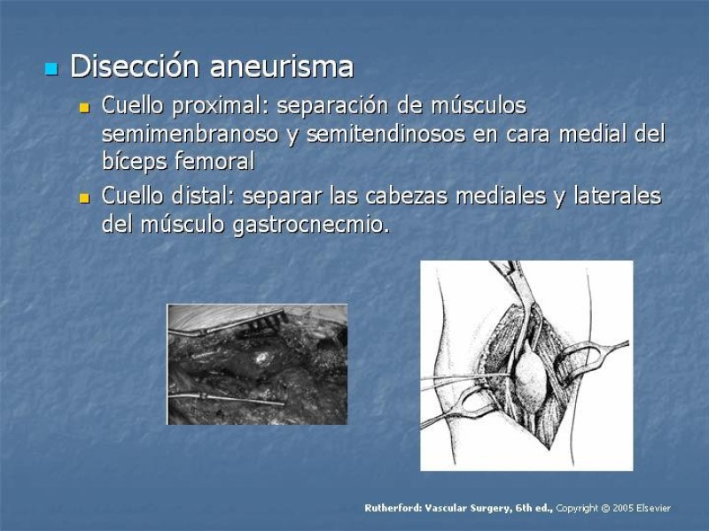 Diapositiva 15 de Aneurisma arterial poplíteo