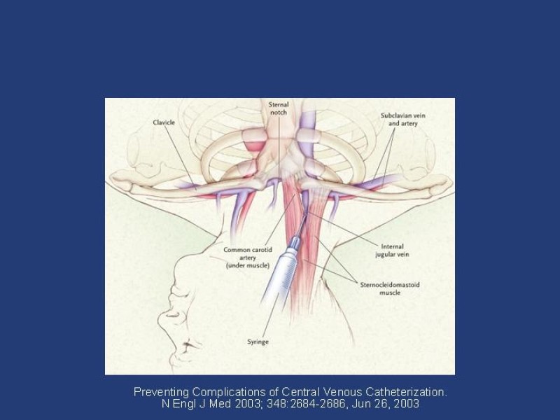 Diapositiva 14 de Accesos venosos centrales