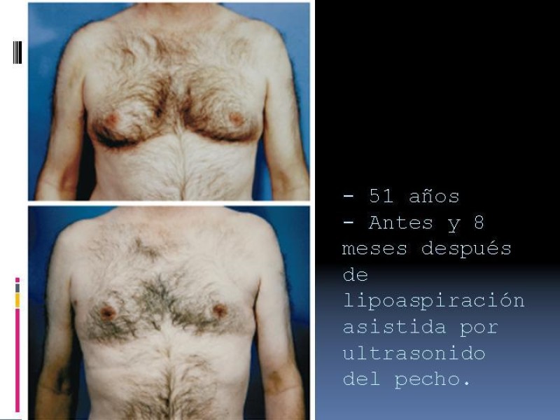 Diapositiva 8 de Liposucción