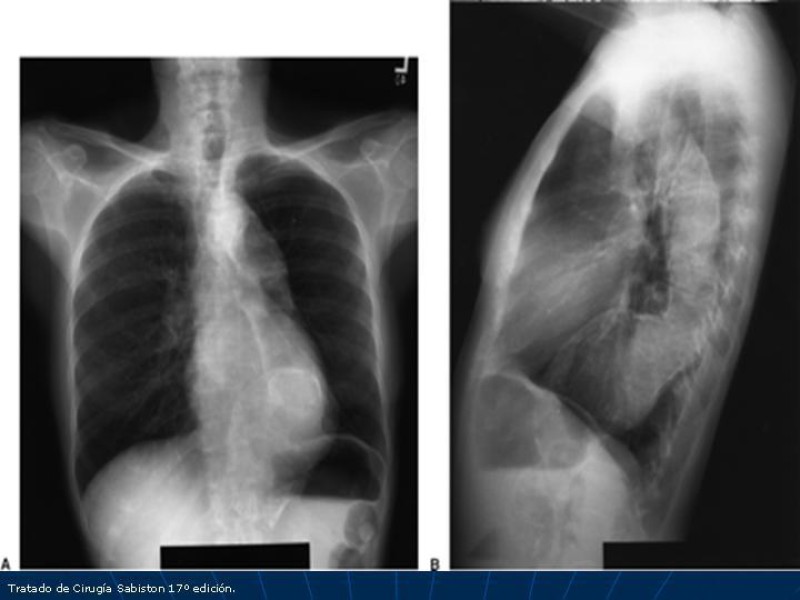 Diapositiva 20 de Aneurisma aórtico toracoabdominal (AATA)