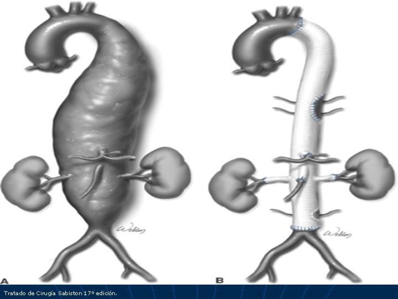 Diapositiva 56 de Aneurisma aórtico toracoabdominal (AATA)