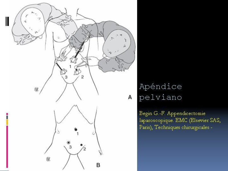 Diapositiva 31 de Apendicitis aguda