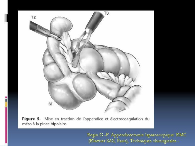 Diapositiva 32 de Apendicitis aguda