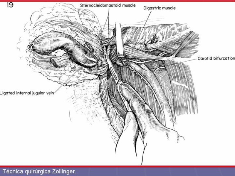 Diapositiva 36 de Disección Cervical Pt. 2