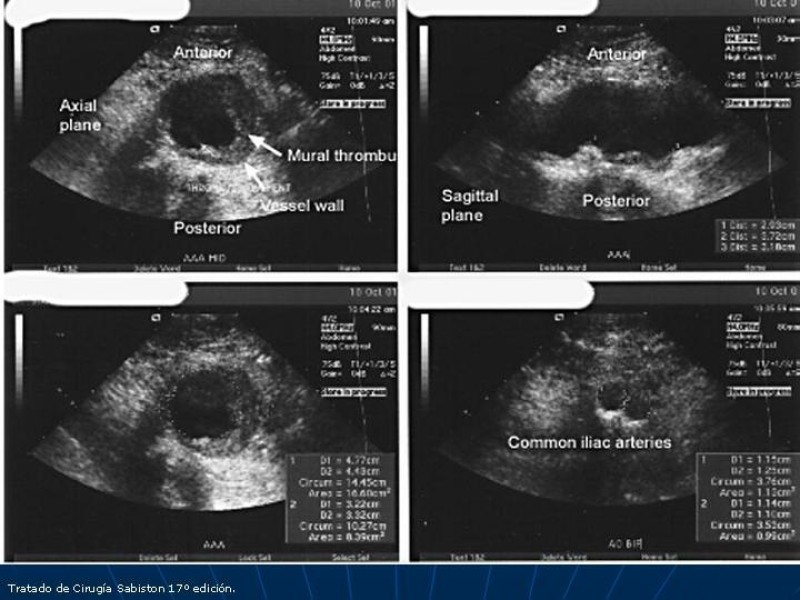 Diapositiva 28 de Aneurisma aórtico toracoabdominal (AATA)
