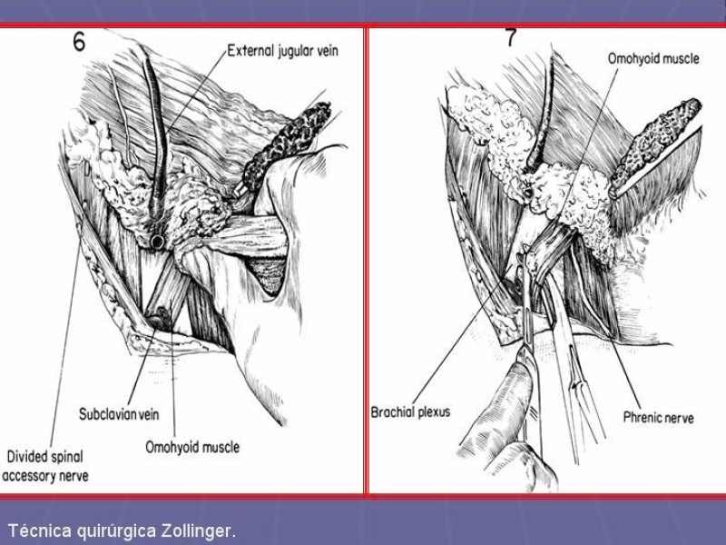 Diapositiva 20 de Disección Cervical Pt. 2