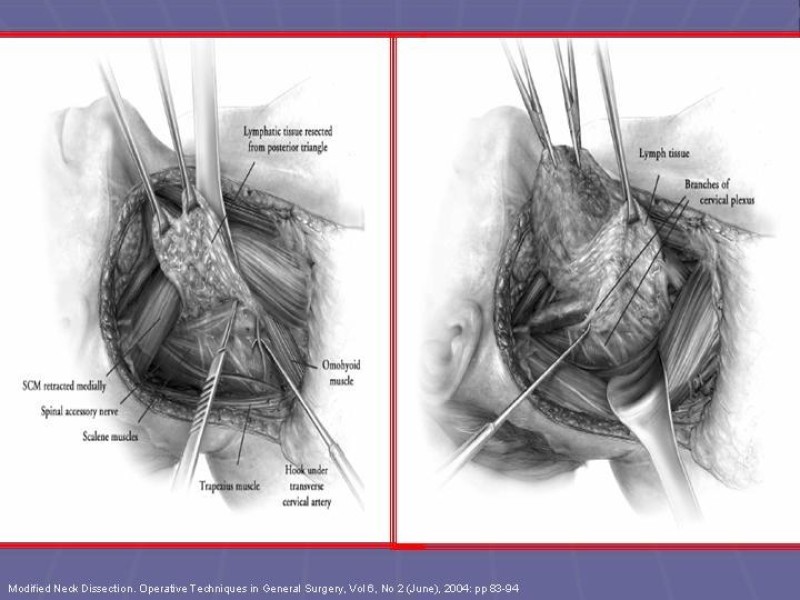 Diapositiva 46 de Disección Cervical Pt. 2