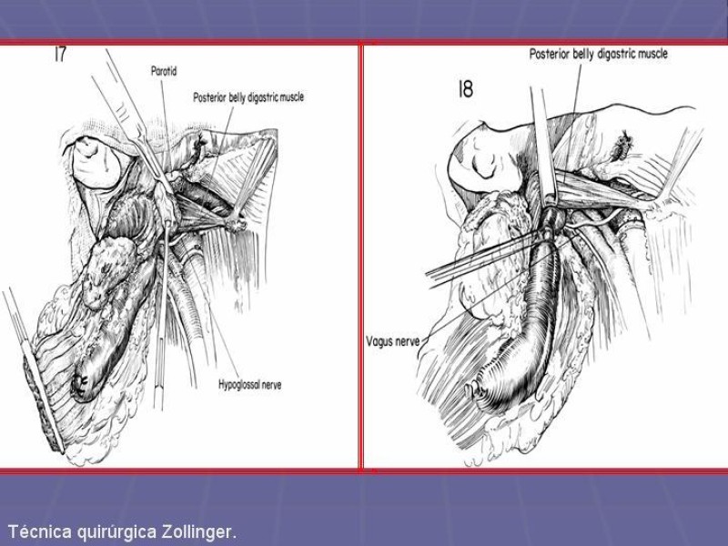 Diapositiva 35 de Disección Cervical Pt. 2