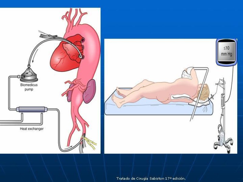 Diapositiva 54 de Aneurisma aórtico toracoabdominal (AATA)