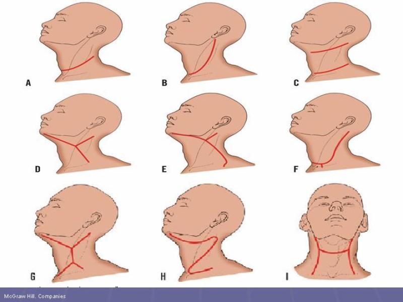 Diapositiva 44 de Disección Cervical Pt. 1