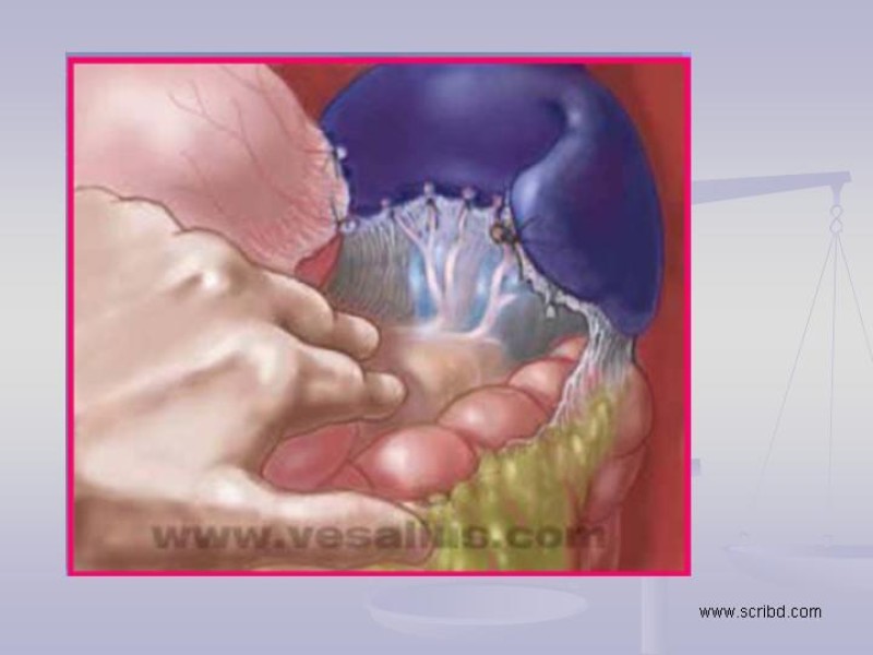 Diapositiva 16 de Técnica Quirúrgica Esplenectomía