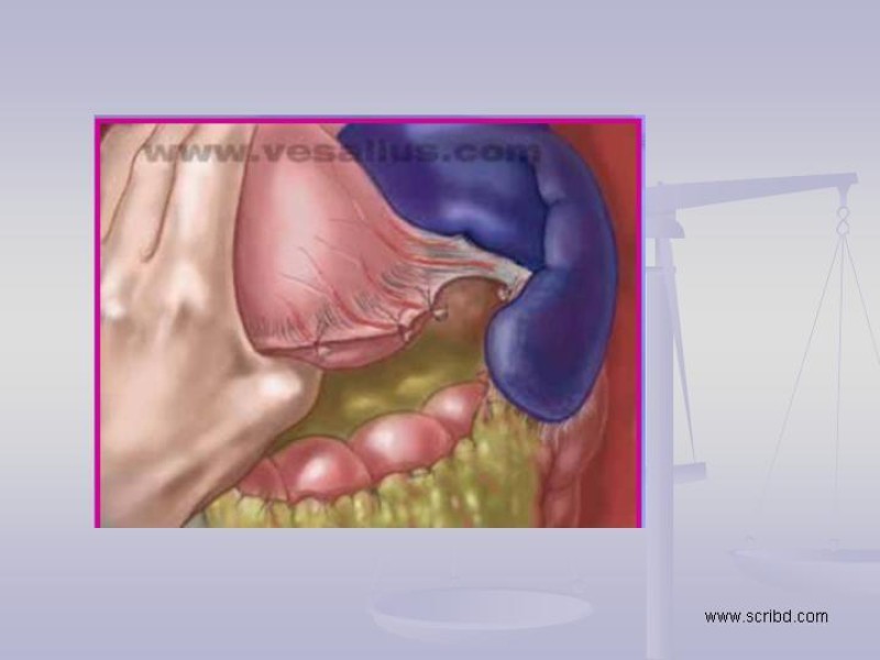 Diapositiva 14 de Técnica Quirúrgica Esplenectomía