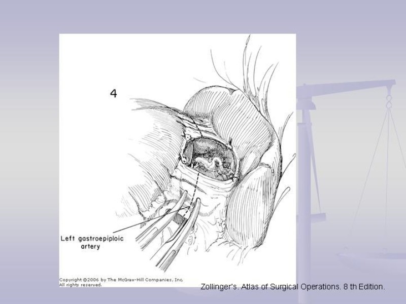 Diapositiva 20 de Técnica Quirúrgica Esplenectomía