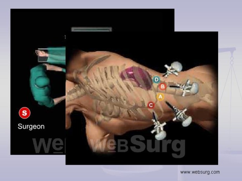 Diapositiva 26 de Técnica Quirúrgica Esplenectomía