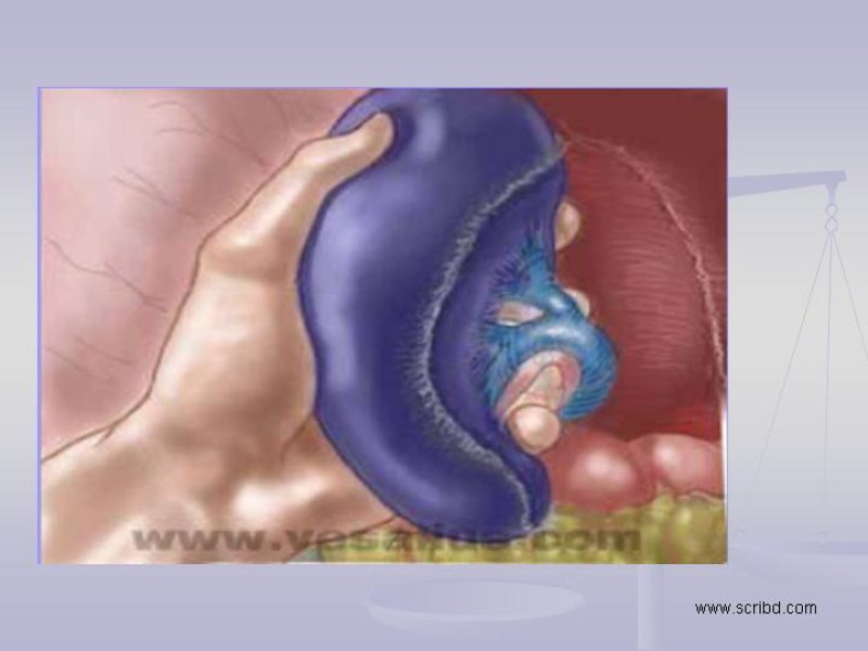 Diapositiva 17 de Técnica Quirúrgica Esplenectomía