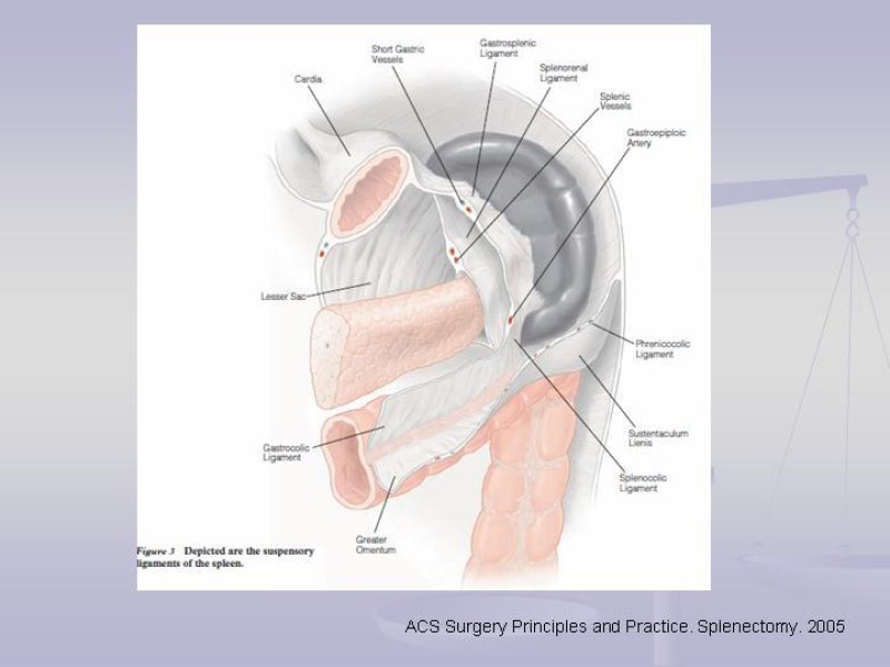 Diapositiva 4 de Técnica Quirúrgica Esplenectomía