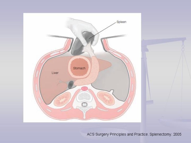 Diapositiva 22 de Técnica Quirúrgica Esplenectomía