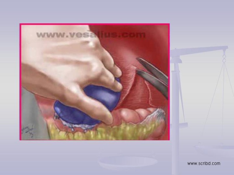Diapositiva 15 de Técnica Quirúrgica Esplenectomía