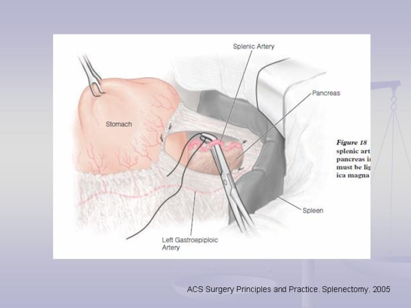 Diapositiva 19 de Técnica Quirúrgica Esplenectomía