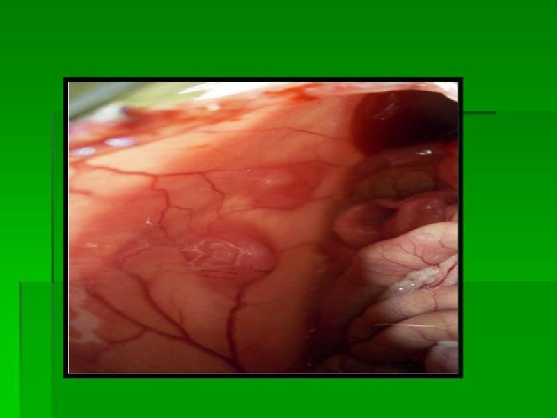 Diapositiva 12 de Ascitis Asociada a Malignidad