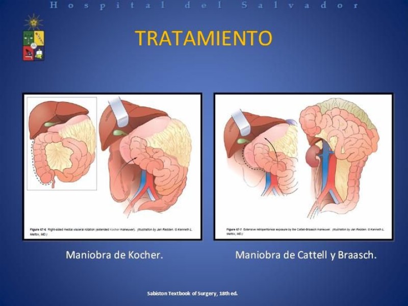 Diapositiva 20 de Trauma Duodenal