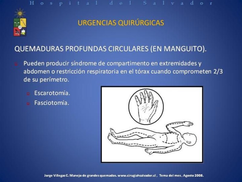 Diapositiva 32 de Gran Quemado