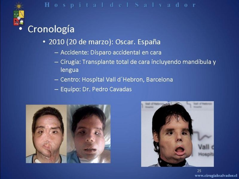 Diapositiva 24 de Transplante Facial