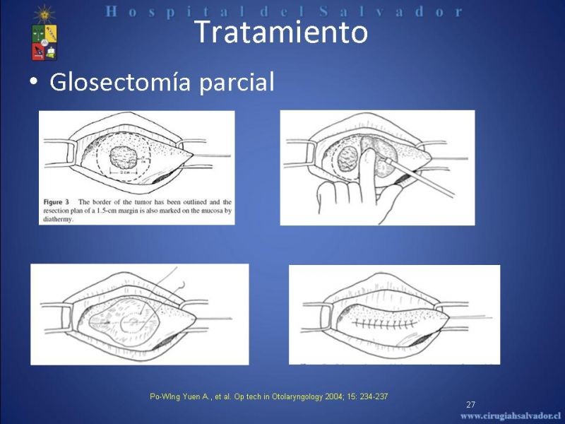 Diapositiva 26 de Cáncer de Lengua