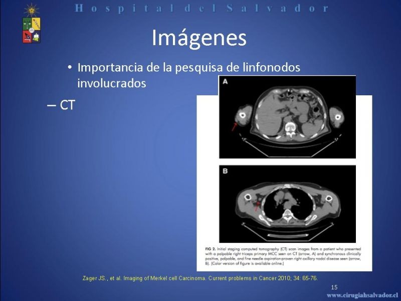 Diapositiva 14 de Carcinoma de Células de Merkel