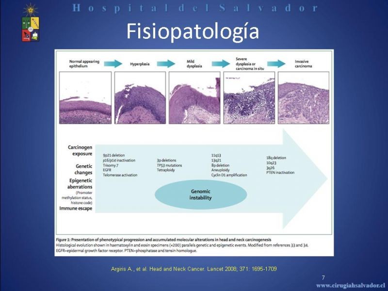 Diapositiva 6 de Cáncer de Lengua