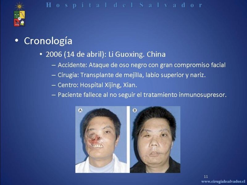 Diapositiva 10 de Transplante Facial