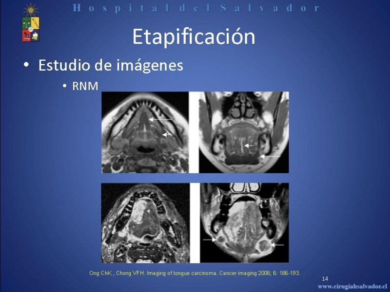 Diapositiva 13 de Cáncer de Lengua
