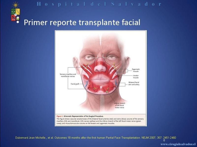 Diapositiva 7 de Transplante Facial