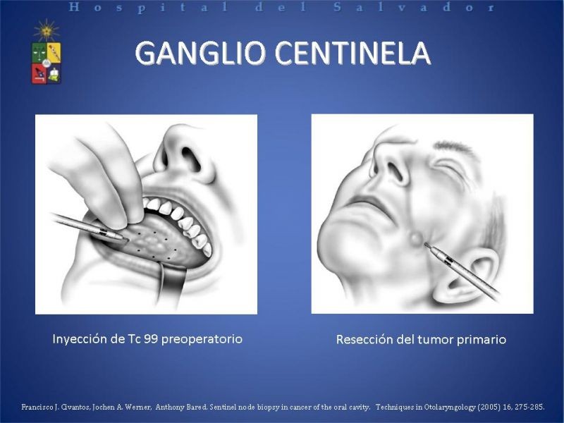 Diapositiva 6 de Biopsia de Ganglio Centinela en Cáncer de Cabeza y Cuello