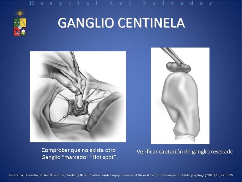 Diapositiva 8 de Biopsia de Ganglio Centinela en Cáncer de Cabeza y Cuello
