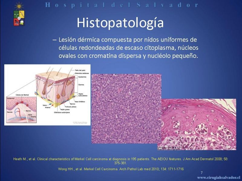 Diapositiva 6 de Carcinoma de Células de Merkel