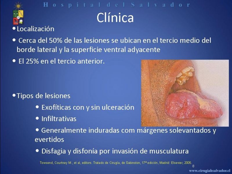 Diapositiva 7 de Cáncer de Lengua