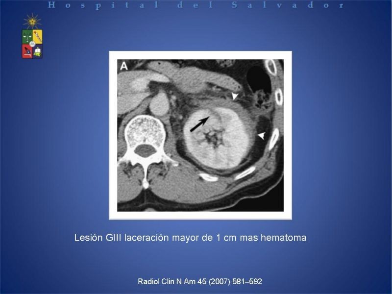 Diapositiva 9 de Trauma Renal