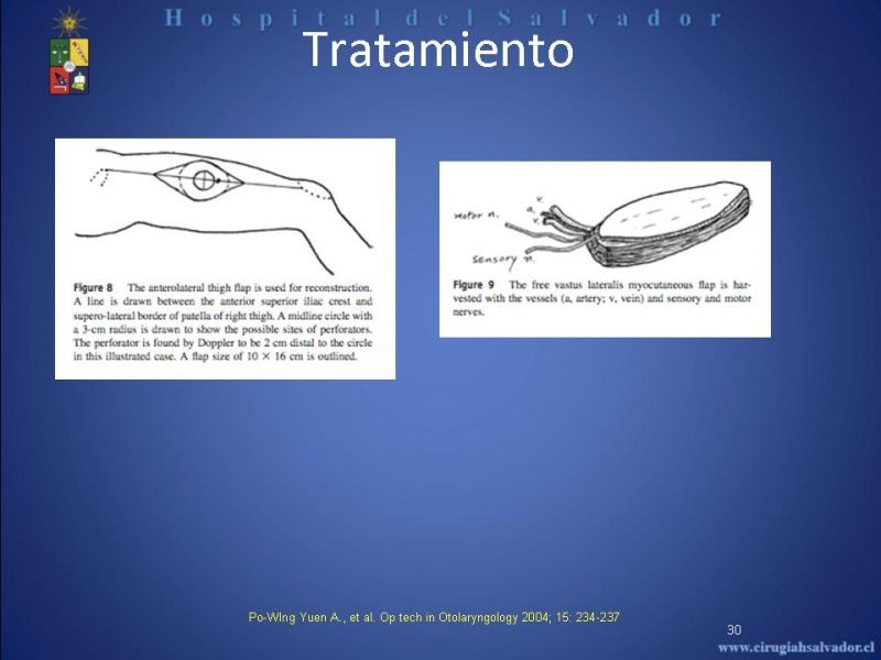 Diapositiva 29 de Cáncer de Lengua