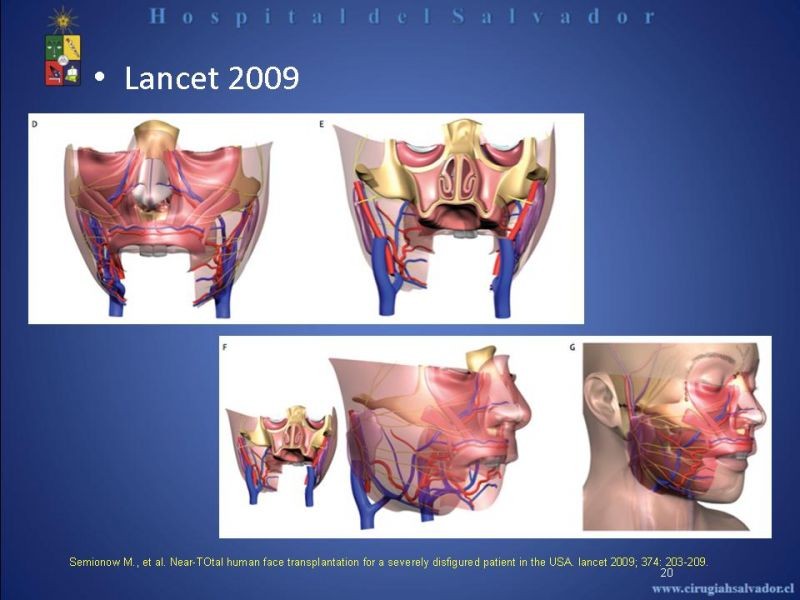 Diapositiva 19 de Transplante Facial