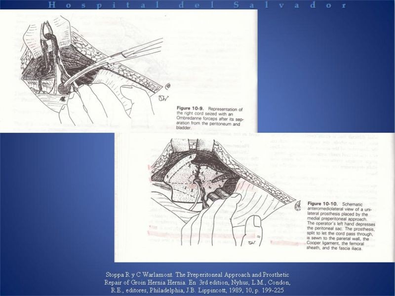 Diapositiva 17 de Técnica quirúrgica: Stoppa