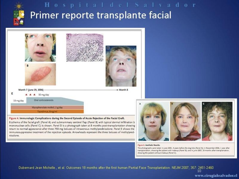 Diapositiva 9 de Transplante Facial