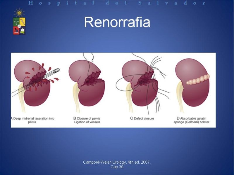 Diapositiva 17 de Trauma Renal