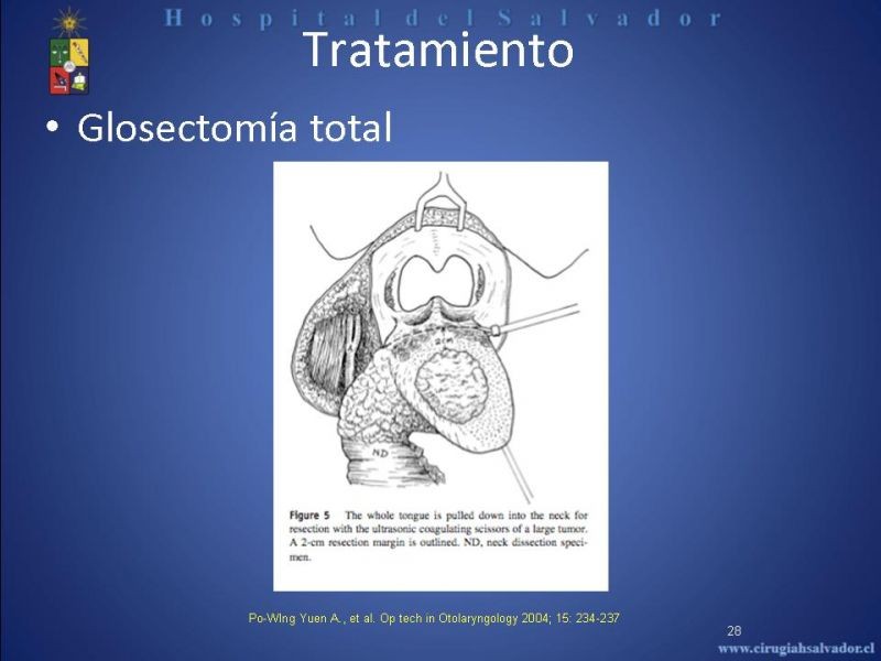 Diapositiva 27 de Cáncer de Lengua