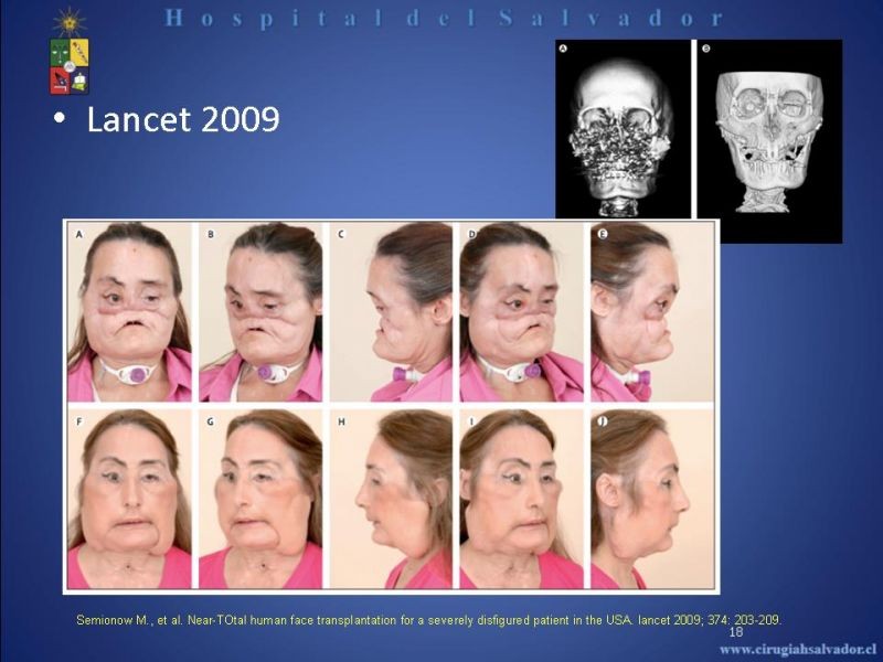 Diapositiva 17 de Transplante Facial