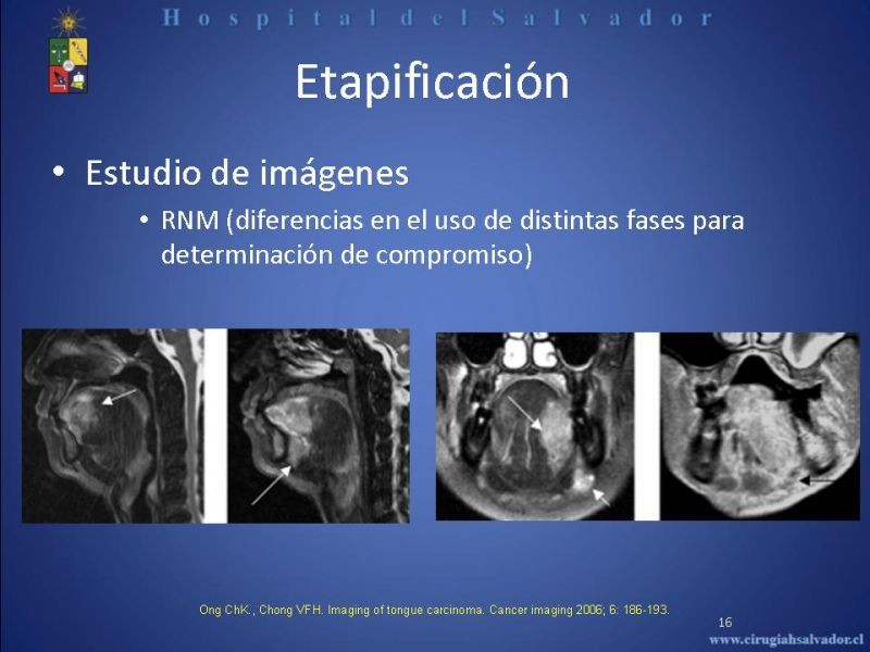 Diapositiva 15 de Cáncer de Lengua