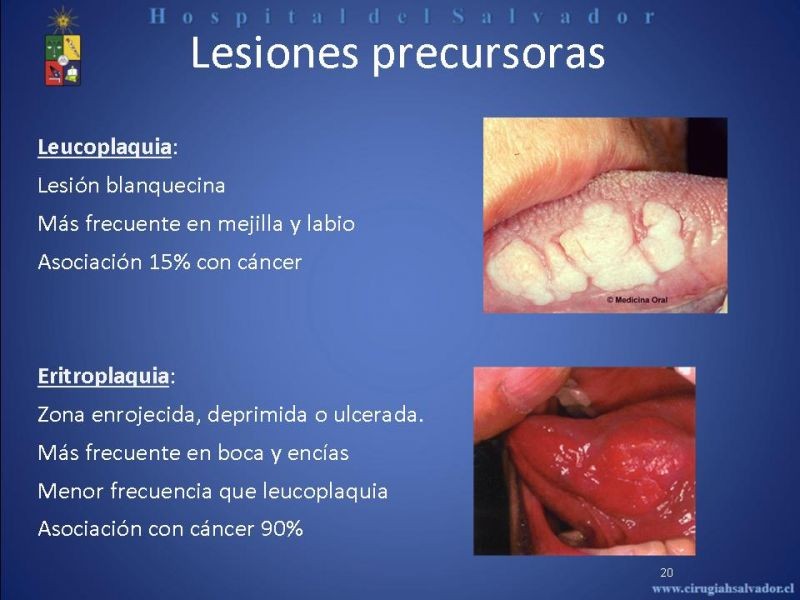 Diapositiva 19 de Cáncer de Lengua