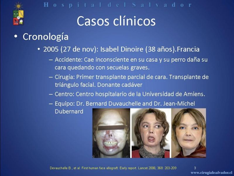 Diapositiva 2 de Transplante Facial